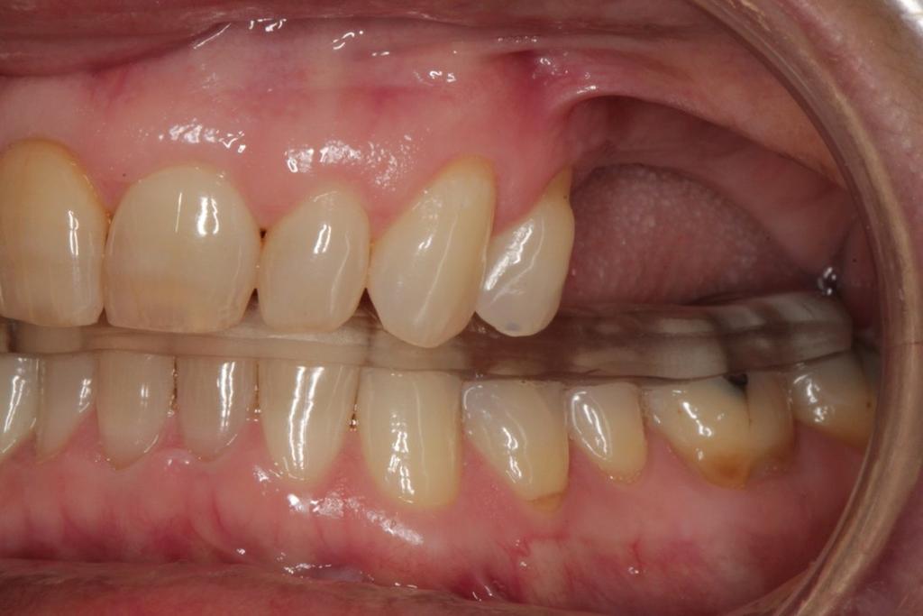 When more teeth are missing on the lower than the upper, it is possible to make a lower splint that fills in the