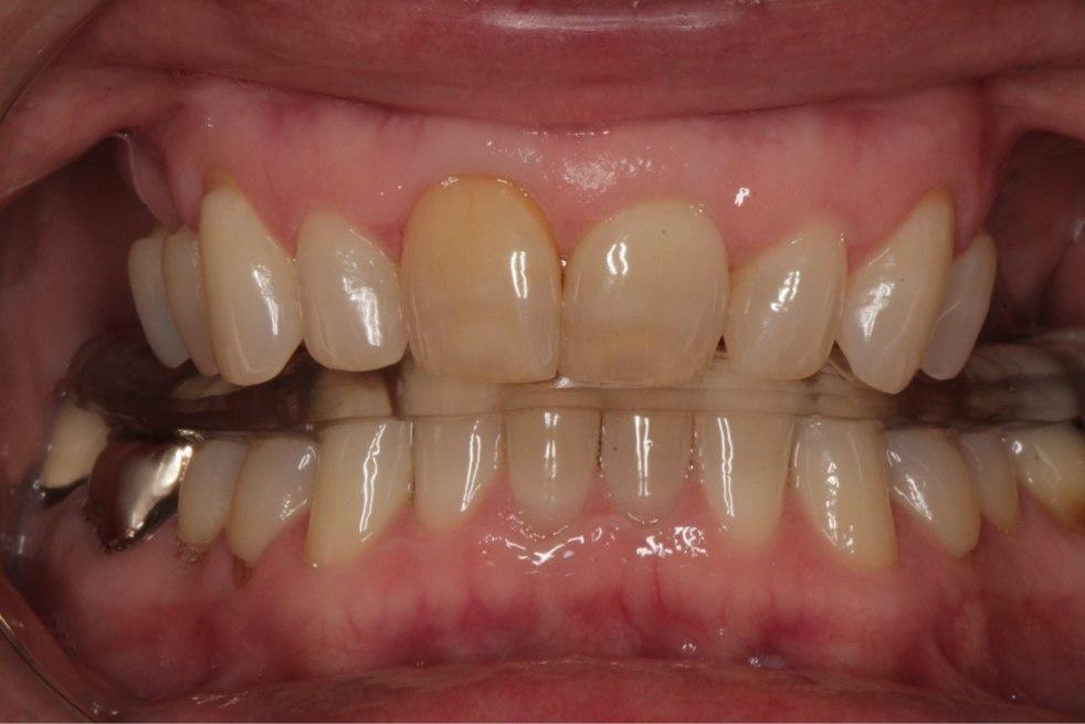INCOMPLETE OCCLUSAL SCHEMES For this deep bite case, a lower flat plane splint allows a