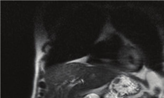 The imaging findings demonstrated no vascularity of the lesion.