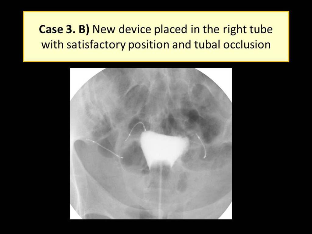 Fig. 7: Case 3. B) A new device was placed in the right tube.