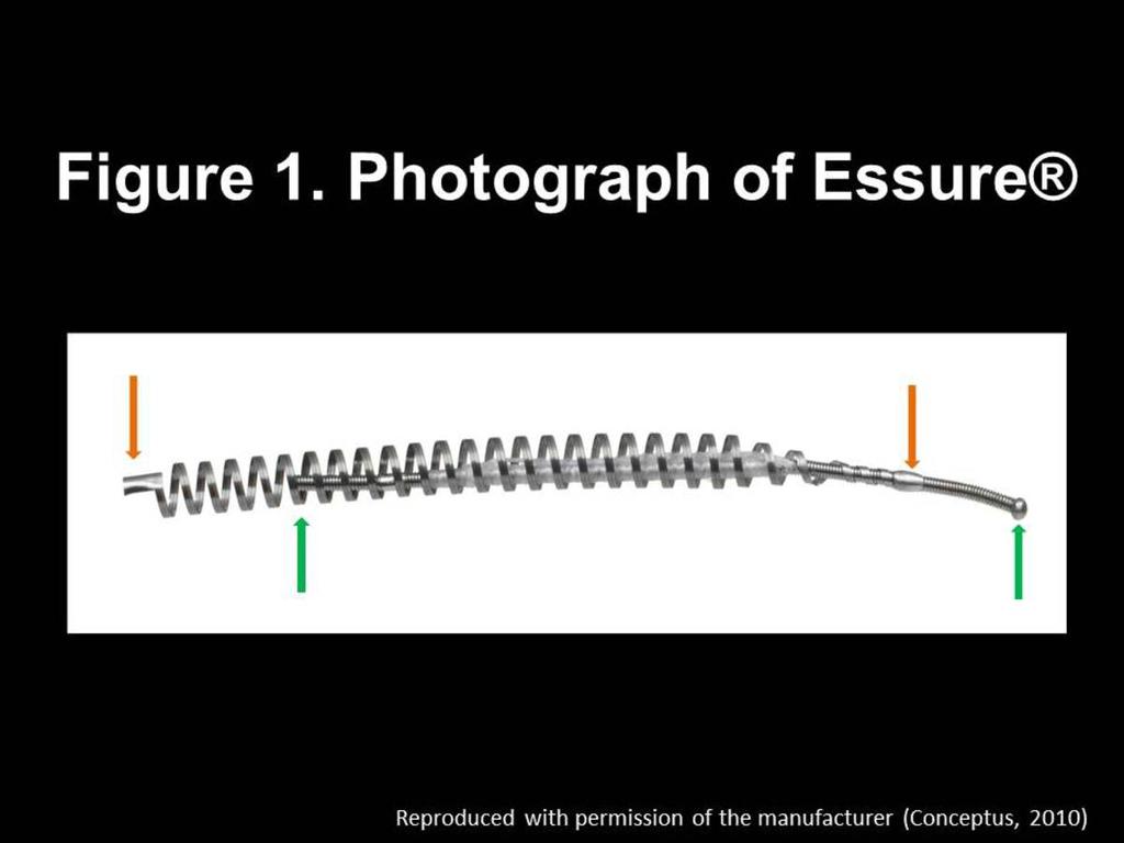 Fig. 1: This image shows Essure device, which consists of two coils, an outer coil and an inner coil.