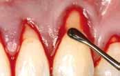 gingival plastic for leveling of the FST ginal tissue Covering of