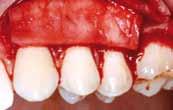 recession at tooth 43 before the treatment with mucoderm matrix Preparation of a split