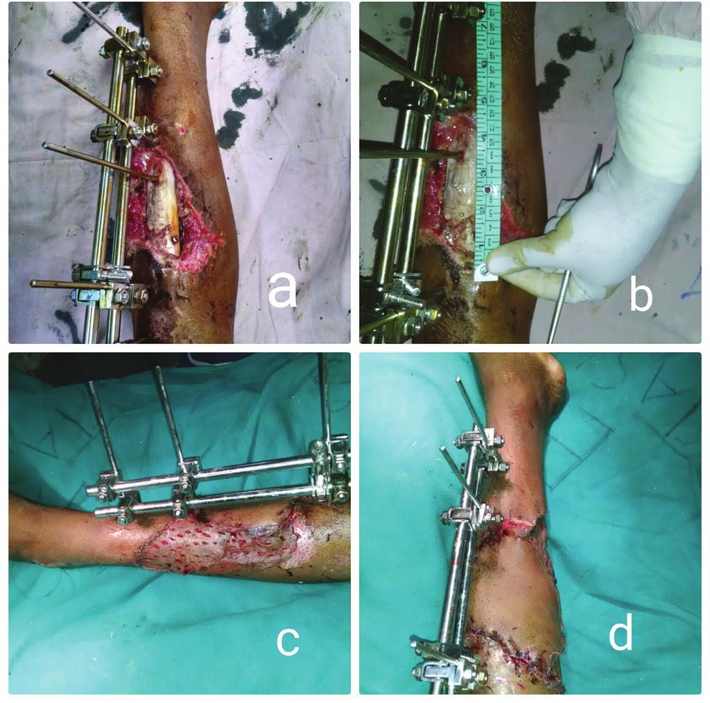 Intra-operative pictures of debridement and raising of medial gastrocnemius myocutaneous flap. D. Post-operative picture after insetting. E.