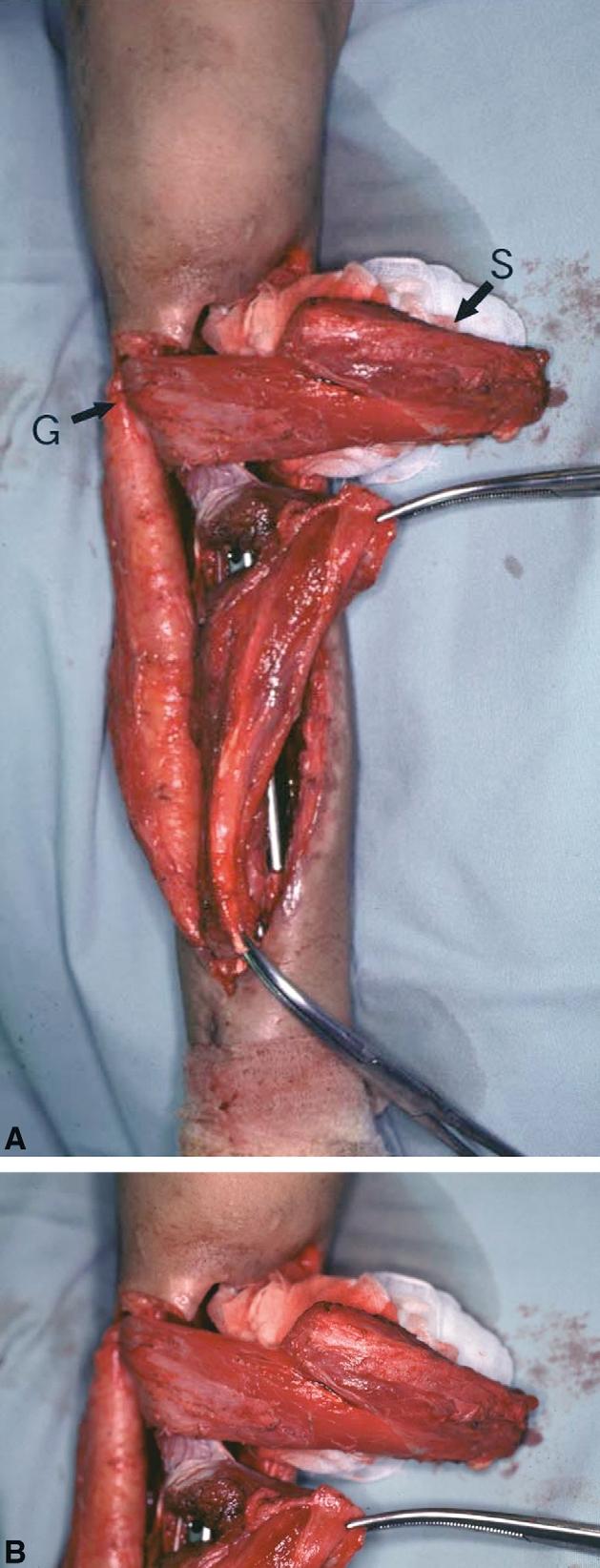 80 I. Hyodo et al. adjuvant chemotherapy postoperatively. In the first operation wide resection of the tumour was performed and the proximal anterior tibial artery and vein was resected.