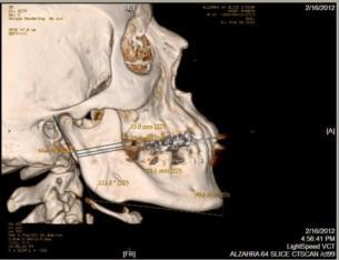 Mandibular Dimensional Changes with aging 5. Mandibular body length (anterior margin of chin to gonion) 6.