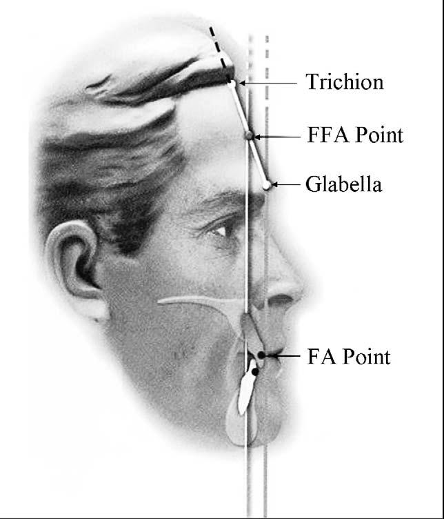 (A) A patient with an acute nasolabial angle with the maxillary central incisors positioned well behind glabella.