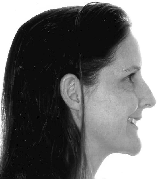 The study sample consisted of facial profile photographs from pretreatment records of a random sample of 94 of adult white females seeking orthodontic treatment.