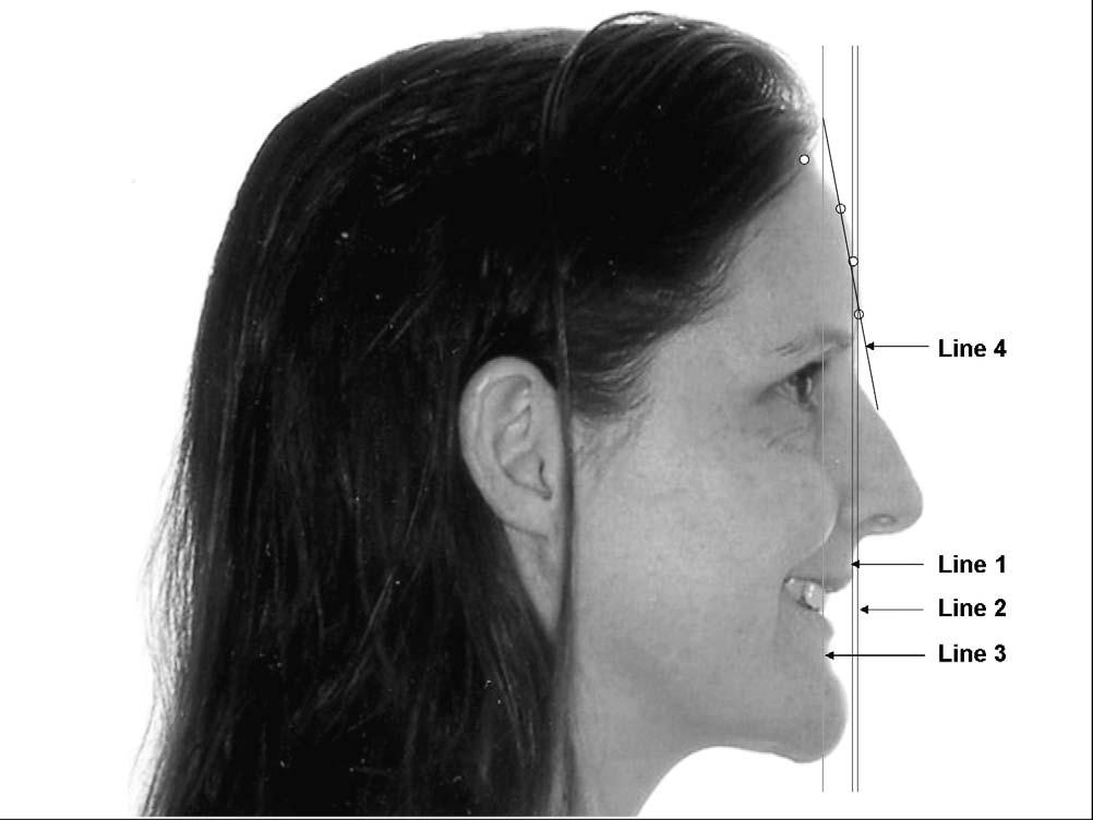 MAXILLARY CENTRAL INCISORS TO THE FOREHEAD AP 665 Figure 6. Reference lines used in the study. Line 1 is through the forehead s FFA point. Line 2 is through glabella.