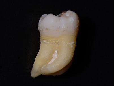 Longitudinal and transversal sections through the bracket-adhesive-tooth samples after being embeded in epoxidic resin for being subjected to ESEM investigations There have been taken into the study