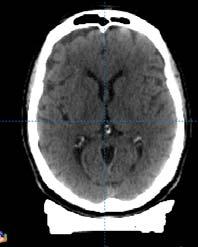 gel dosimetry of Gamma Knife stereotactic radiosurgery systems, Med. Phys.