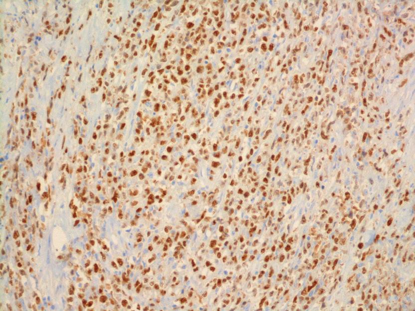 Case Reports in Hematology 3 (a) (b) (c) (d) Figure 2: Immunohistochemical staining pattern and diffuse large B cell lymphoma of the bladder.