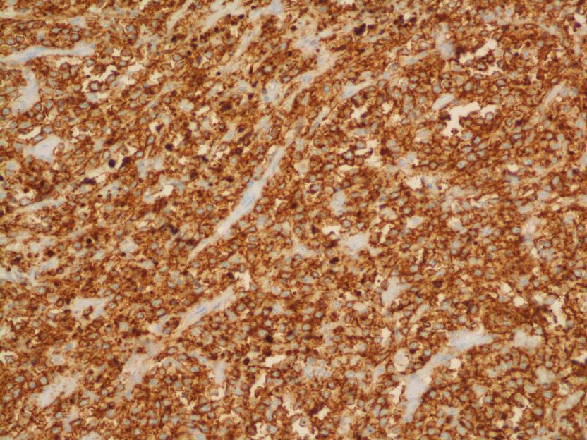 Recent studies [9, 10] have evaluated the application of immunohistochemical stains specific for the TAp63 and ΔNp63 isoforms in the diagnosis of carcinoma.