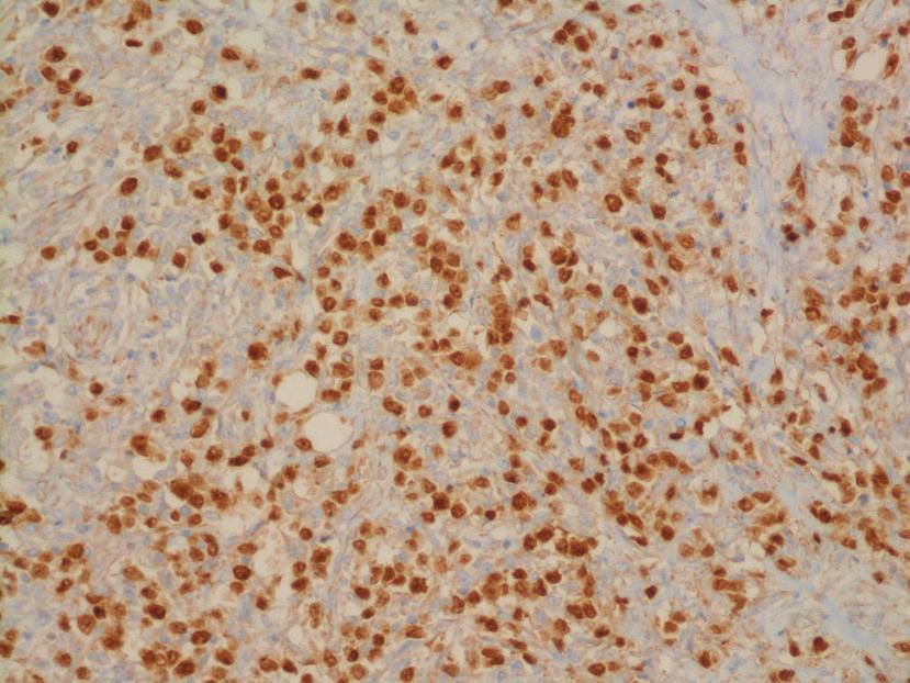 differentiated carcinoma from lymphoma. These immunohistochemical stains were not evaluated in our case, as they were not available in our laboratory at the time.