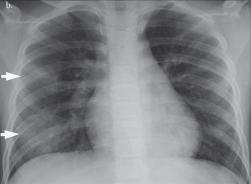 There is complete resolution of the pulmonary opacities. Fig. 1.