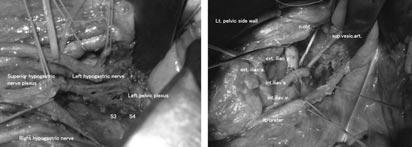 Optimal lymph node dissection for T3-T4 lower rectal cancer, the so-called high risk group: the Japanese experience Fig. 1 - Extended pelvic side wall dissection (TME/TSME+PSD).