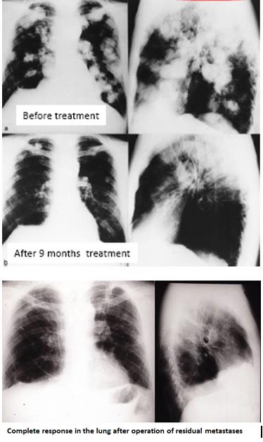 with inhalation of interleukin-2. These patients stopped craving cigarettes, with the added benefit that they did not put on weight.
