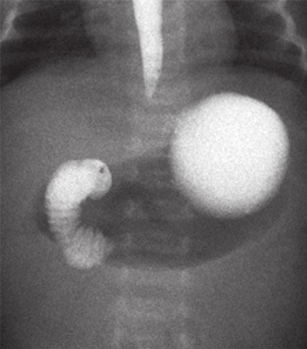 160 E. A. Dunn et l. Fig. 15.3 Intestinl mlrottion results from incomplete rottion nd fixtion of the owel in utero, with the duodenojejunl junction nd cecum lying closer.