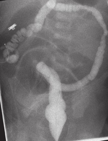 () Mlrottion with midgut volvulus. In the cse of mlrottion with midgut volvulus, contrst mteril fils to pss eyond the ostructed third portion of the duodenum.