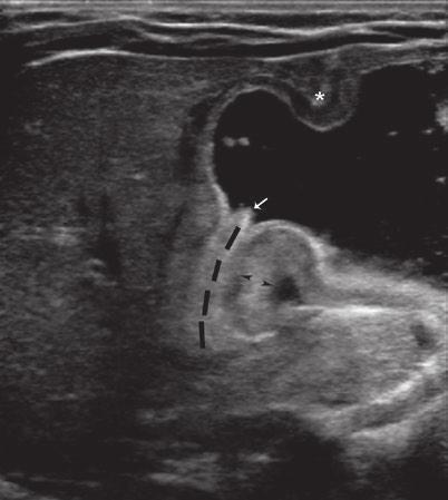 15 The Peditric Gstrointestinl Trct: Wht Every Rdiologist Needs to Know 163 Fig. 15.