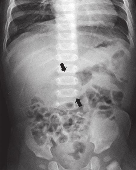 164 E. A. Dunn et l. Fig. 15.10 Intussusception, most commonly ileocolic, hs pek incidence in lte infncy nd presents with dominl distention nd loody stools.