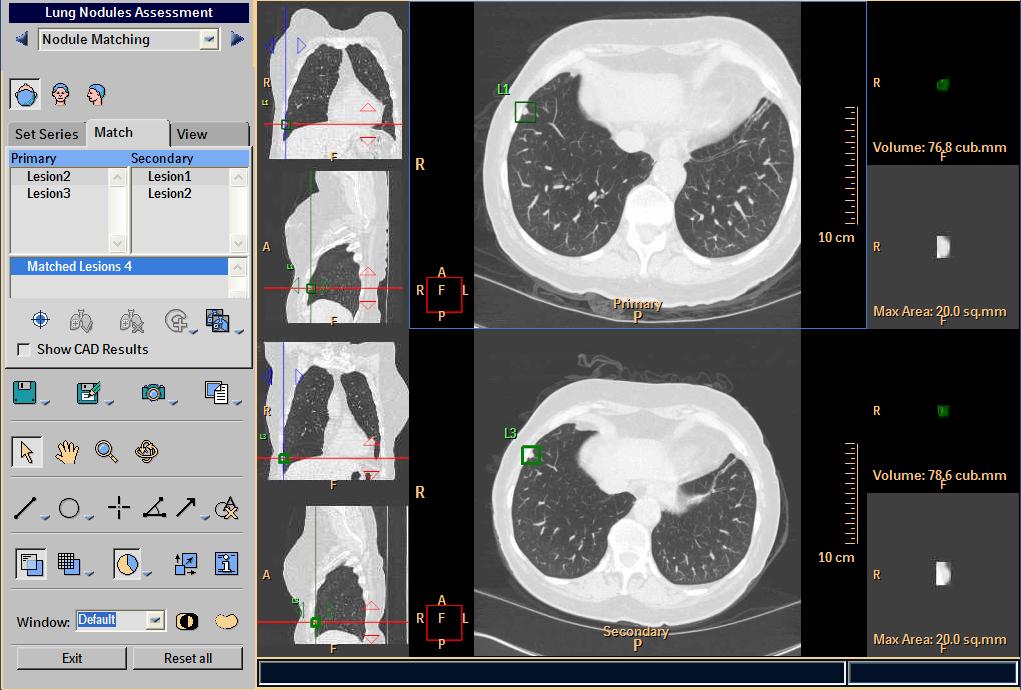 8. Click on the lesions in the list and as matching nodules are identified, click the Match button.