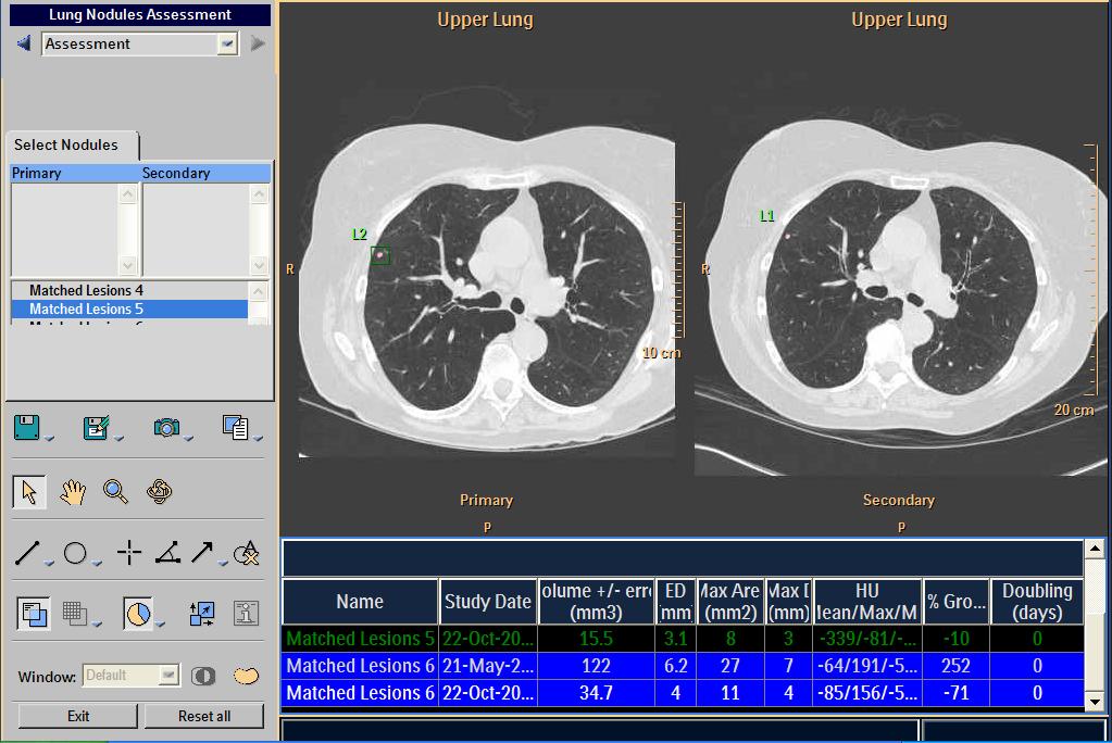 11. The Assessment workflow stage opens. To display the matched nodules in the viewport, click on the lesion(s) in the Select Nodules list.