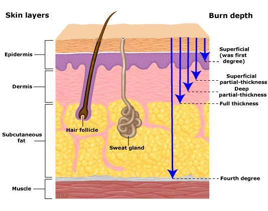 Burn classification Burn Severity In order to determine the need for referral to a specialised burn unit, the American Burn Association devised a classification system to aid in the decision-making