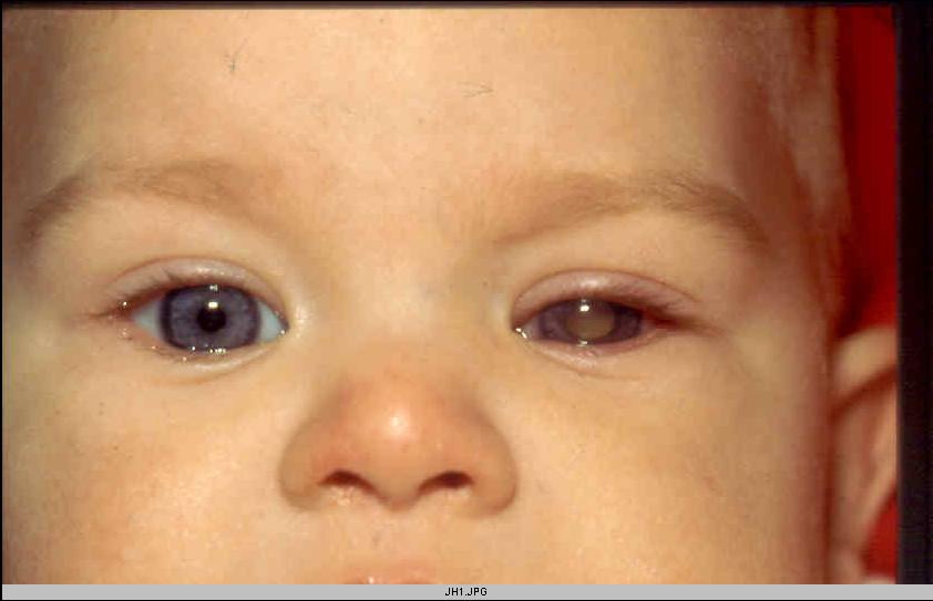 What Does this Baby Have? A. Cataract B. Vitreous Hemorrhage C.