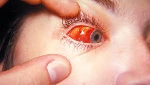 Pharyngoconjunctival Fever = Types 3 and 7 Acute hemorrhagic = Types 11 and