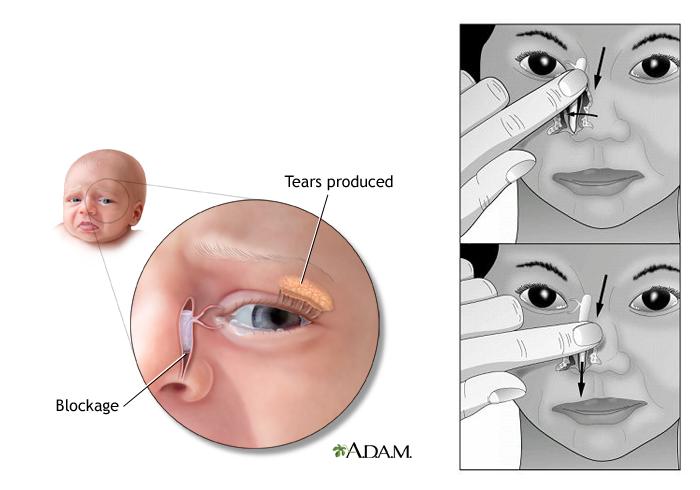 Nasolacrimal Duct Obstruction Congenital vs acquired 5% of newborns Symptoms by 1 month Non-patent at lower end of nasolacrimal duct system Spontaneous resolution in 65% by 6 months, 90% by 1 year