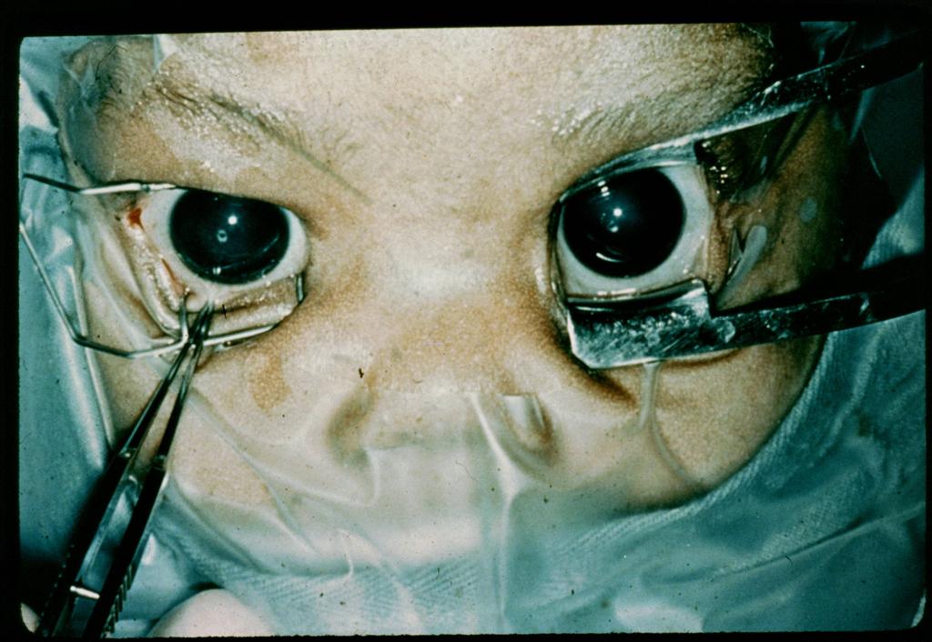 Infantile Glaucoma