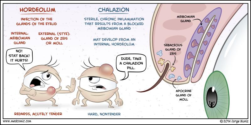 Chalazion/ Hordeolum in Children History: Recurrent history of blepharitis or rosacea Signs and Symptoms