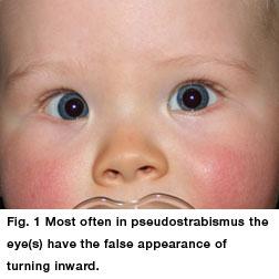 Pseudostrabimus Strabismus is the medical term for eye misalignment