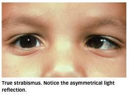 bridge Pseudostrabismus does NOT require treatment and the appearance tends