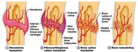 Location in Bone Factors affecting bone healing Age Location in Bone
