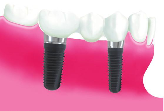 Implant-supported bridges CAMLOG SCREW-LINE implants are as well dedicated for Implant-supported bridges. Implant distribution should be structured in such a way that spanned segments are kept small.