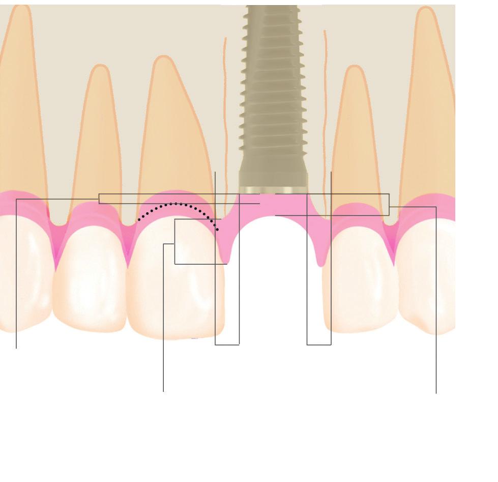 The following aspects should be taken into account during planning: CL (Crown Length) LEVERAGE RATION ON IMPLANT The loading of the implant-bone interface is determined by the leverage ratio from the