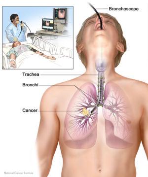 Bronchoscopy 1. This is a test that looks at the inside of the airways. 2. A flexible tube called a bronchoscope is put into the airway. 3.