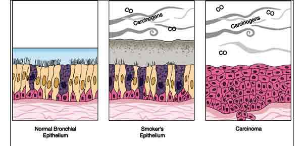 Aims 1) To distinguish smokers develop between COPD and lung cancer.