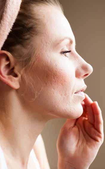 How can Acne be treated? There are many ways to treat Acne but every person is unique and has to find his preferred treatment.