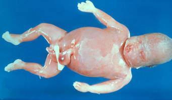 Identifiable Causes of Preterm Birth 1-FETAL Fetal distress Multiple gestation Erythroblastosis Nonimmune hydrops 2-PLACENTAL Placental dysfunction Placenta previa Abruplio placentae 3-UTERINE