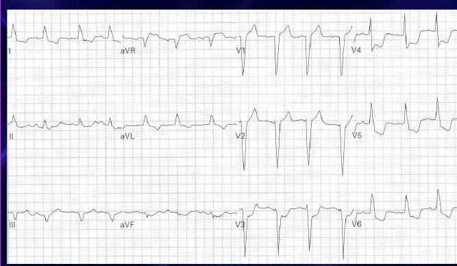 LBBB with?