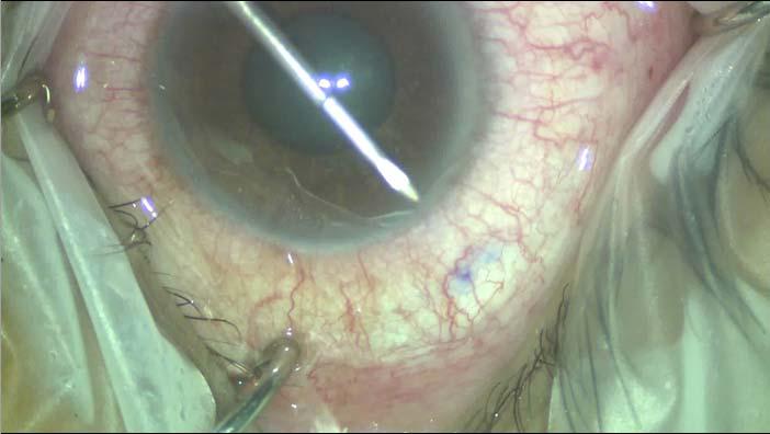 space Aquesys: Flexible tube emerges under conjunctiva 3mm from