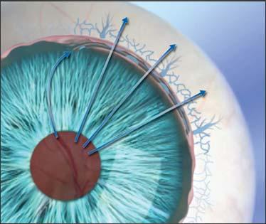 Trabeculotomy - These techniques only affect the anterior chamber to Schlemm s canal