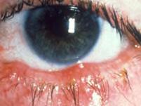 Lid Margin Disease Lid margin disease is a common and frequently chronic inflammation of the eyelids.