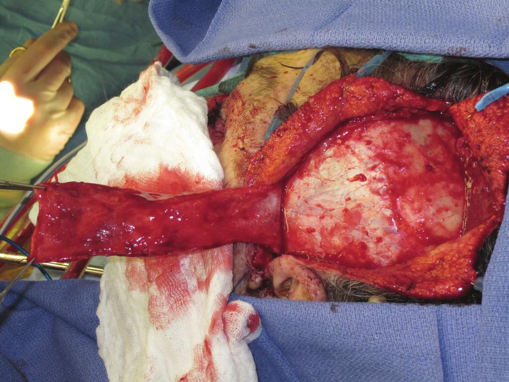 Figure 4: An elliptical skin graft approximately 5 8 cm was removed from the right underarm and was sutured over the TPF. 3.