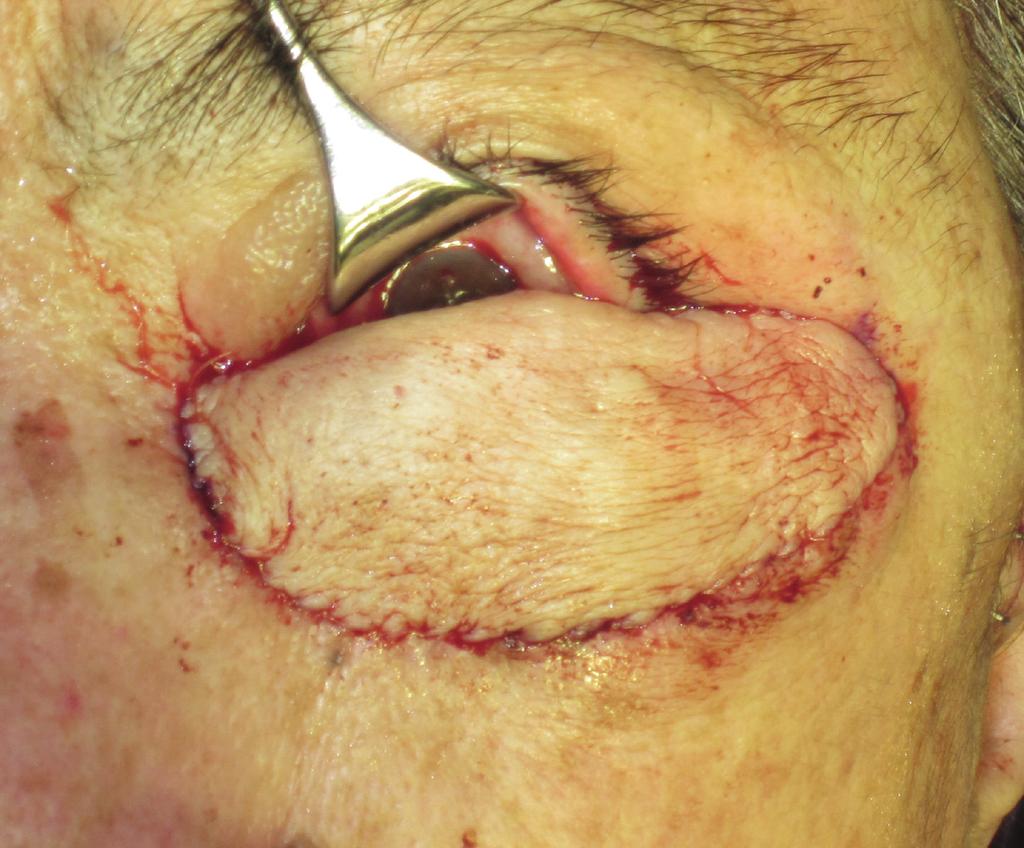 In our case, infiltration of melanoma into the left lower eyelid was the culprit necessitating tissue reconstruction in a viable eye with 20/20 visual acuity.