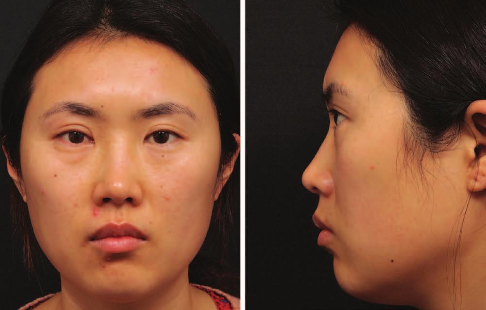 Volume 136, Number 5S Use of Facial Injectables in Asian Patients Fig. 1. (Left) A young Asian woman with short and square face.