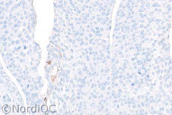 Focally the neoplastic cells show a strong and distinct staining reaction. No background staining is seen.